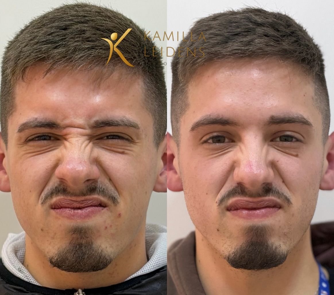Antes e depois de Botox masculino, paciente franzindo o nariz