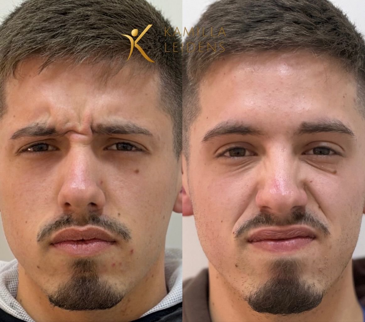 Antes e depois de Botox masculino na glabela, paciente franzindo a testa
