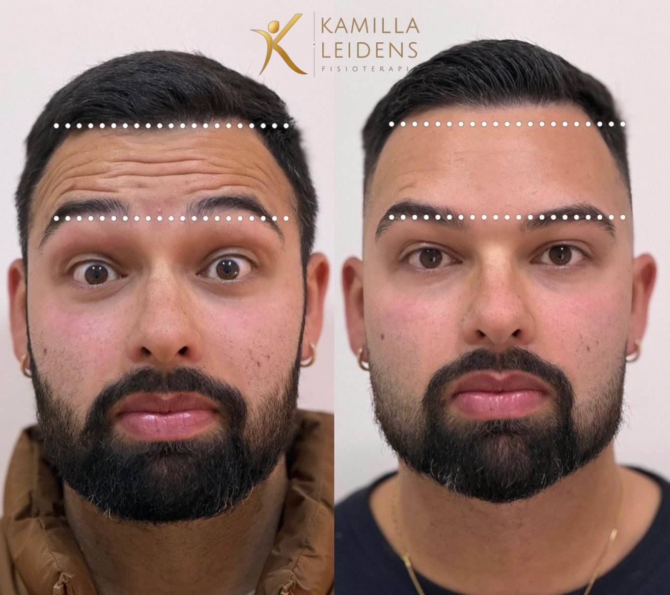 Antes e depois de Botox masculino preventivo na testa