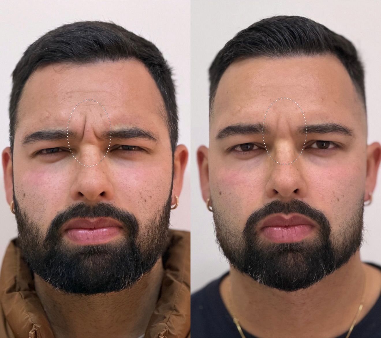 Antes e depois de Botox masculino na glabela