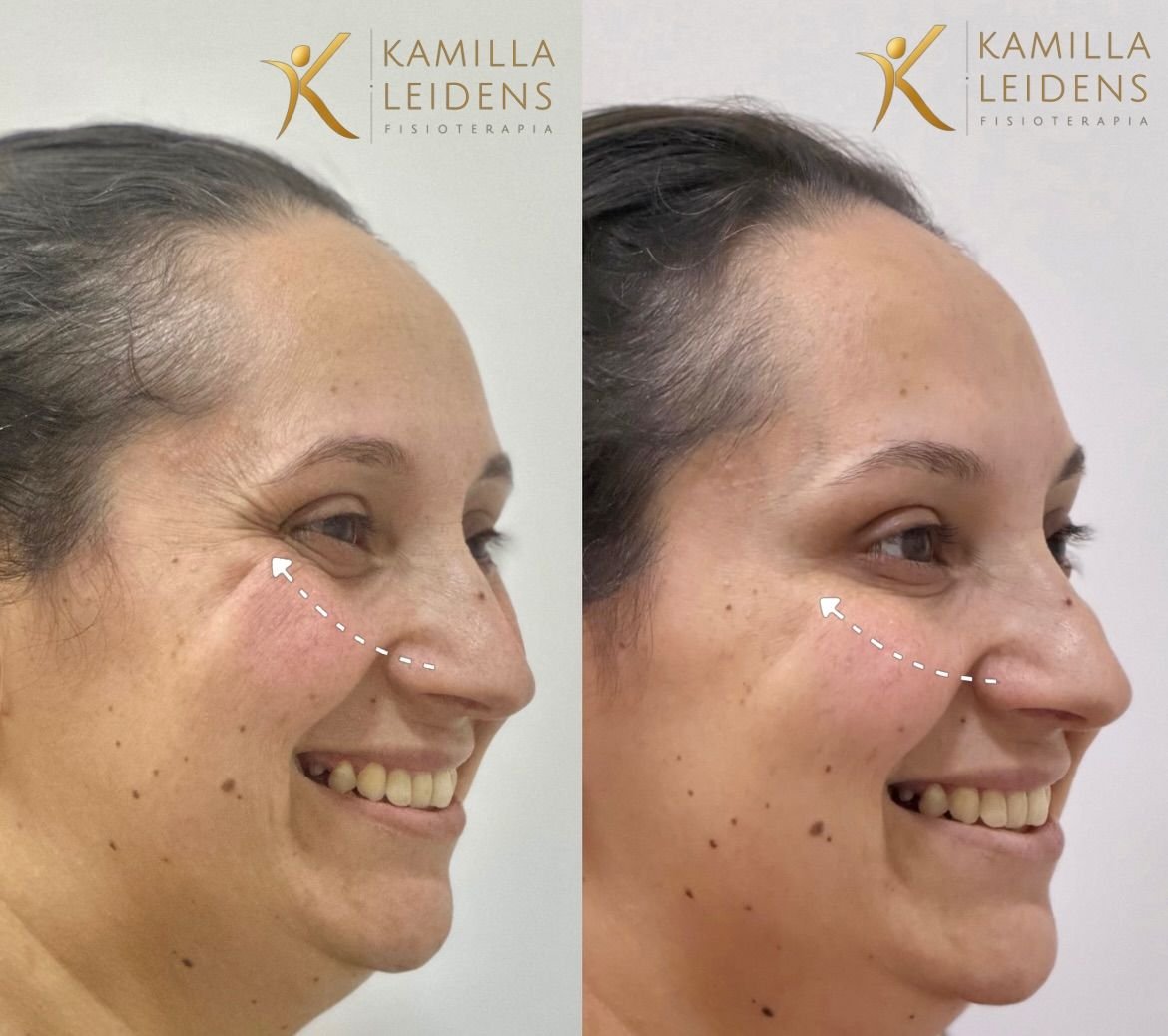 Antes e depois de Botox nos pés de galinha, paciente sorrindo de perfil