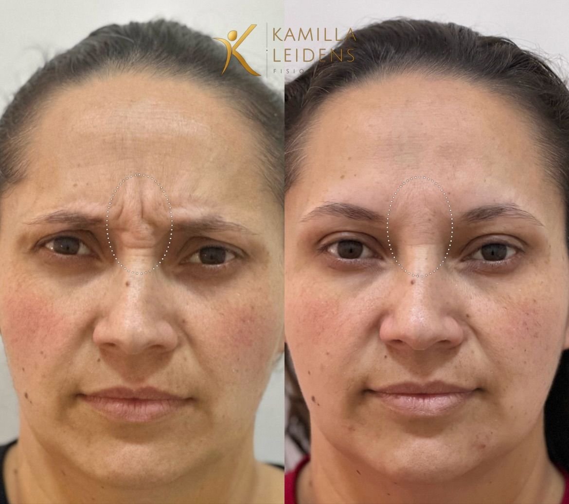 Antes e depois de Botox na glabela, paciente com a testa franzida
