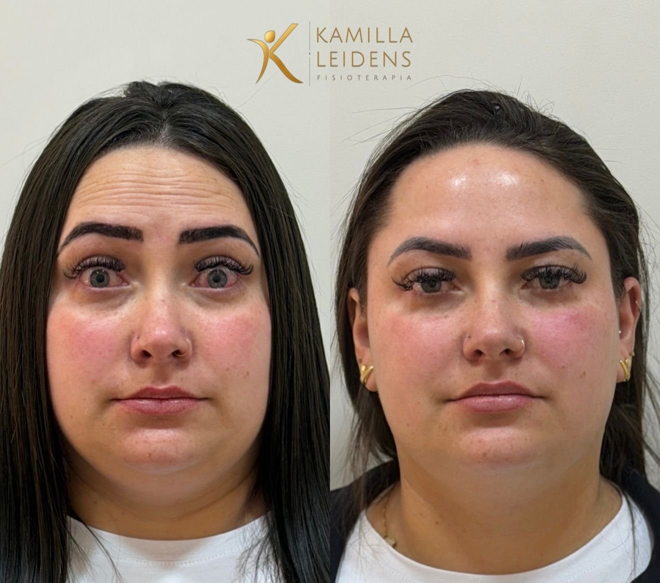 Antes e depois de Botox, paciente franzindo a testa e o nariz