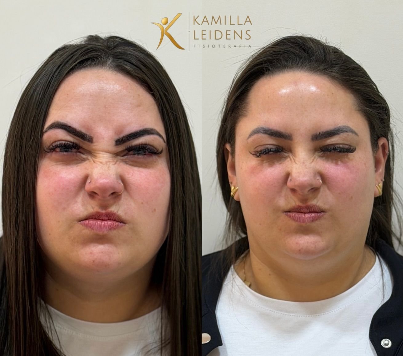 Antes e depois de Botox nos pés de galinha, paciente sorrindo de perfil