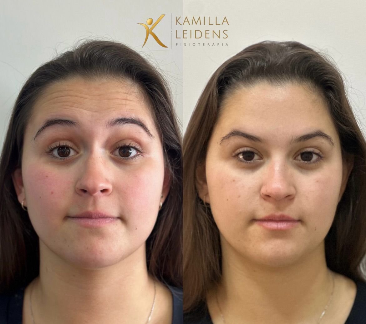 Antes e depois de Botox preventivo, paciente jovem com expressão neutra