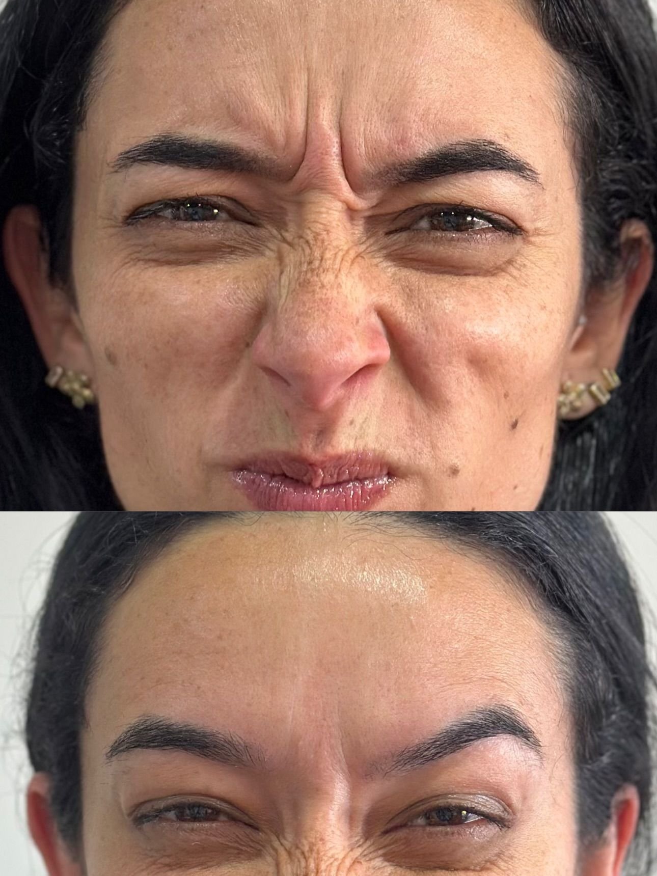 Antes e depois de Botox, paciente franzindo o rosto