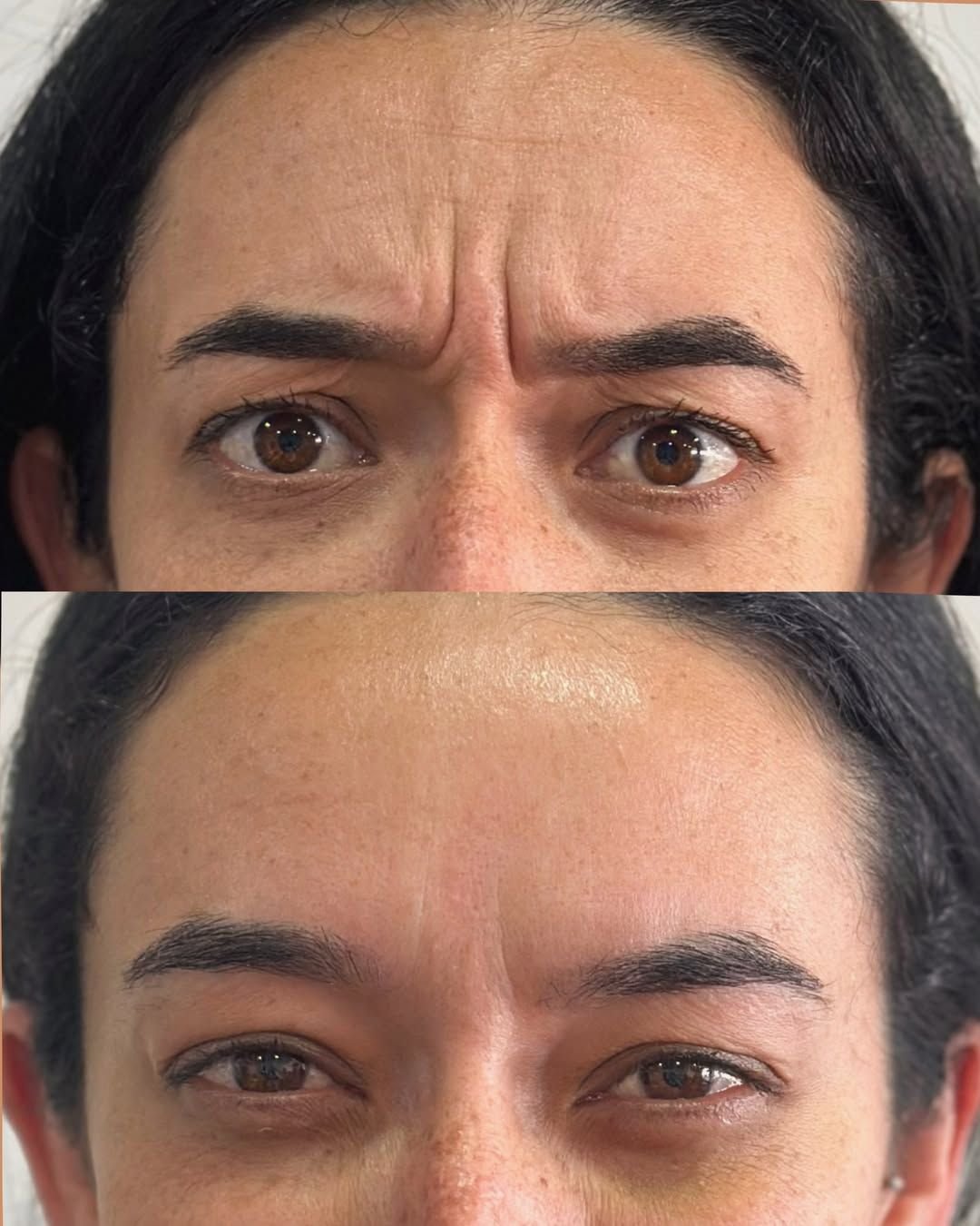 Antes e depois de 15 dias de Botox no terço superior, paciente franzindo a testa