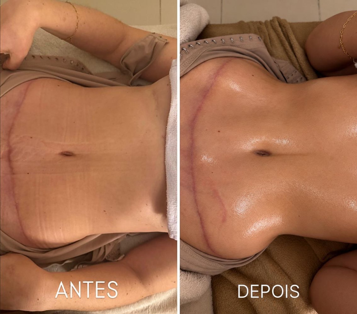 Antes e depois de drenagem linfática no pós-operatório de abdômen
