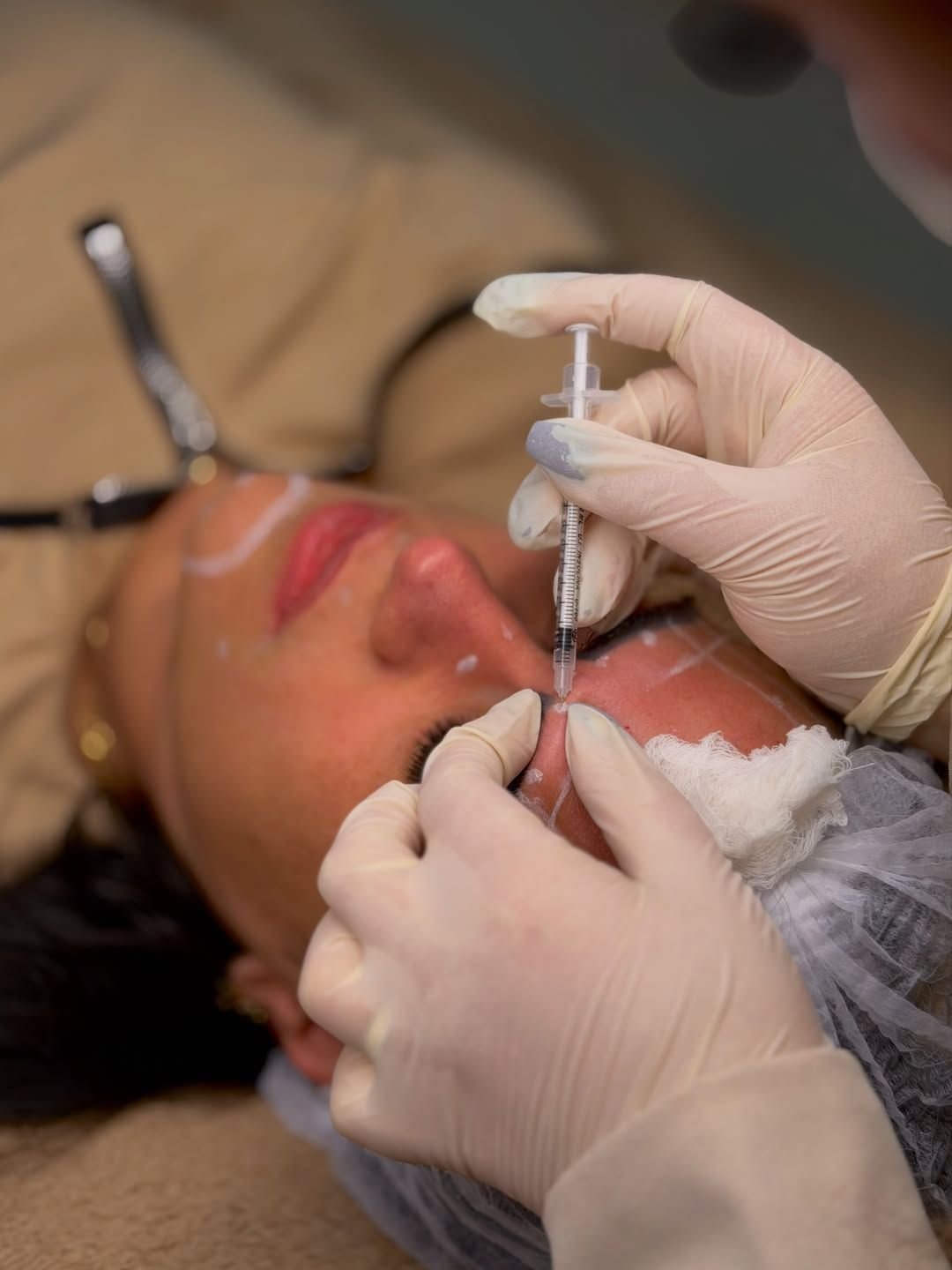 Aplicação de Botox na região dos olhos