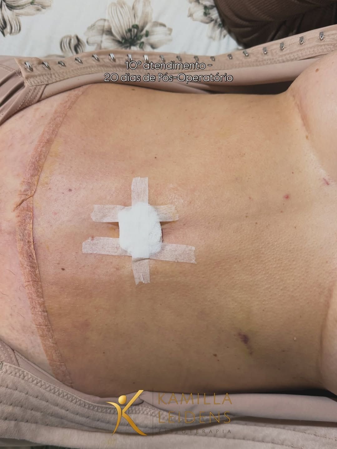 Abdômen em recuperação de cirurgia com curativo, durante acompanhamento pós-operatório